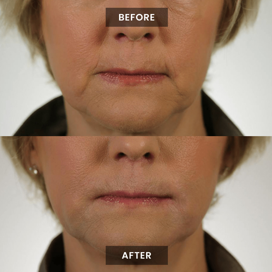 Xeomin before and after photo